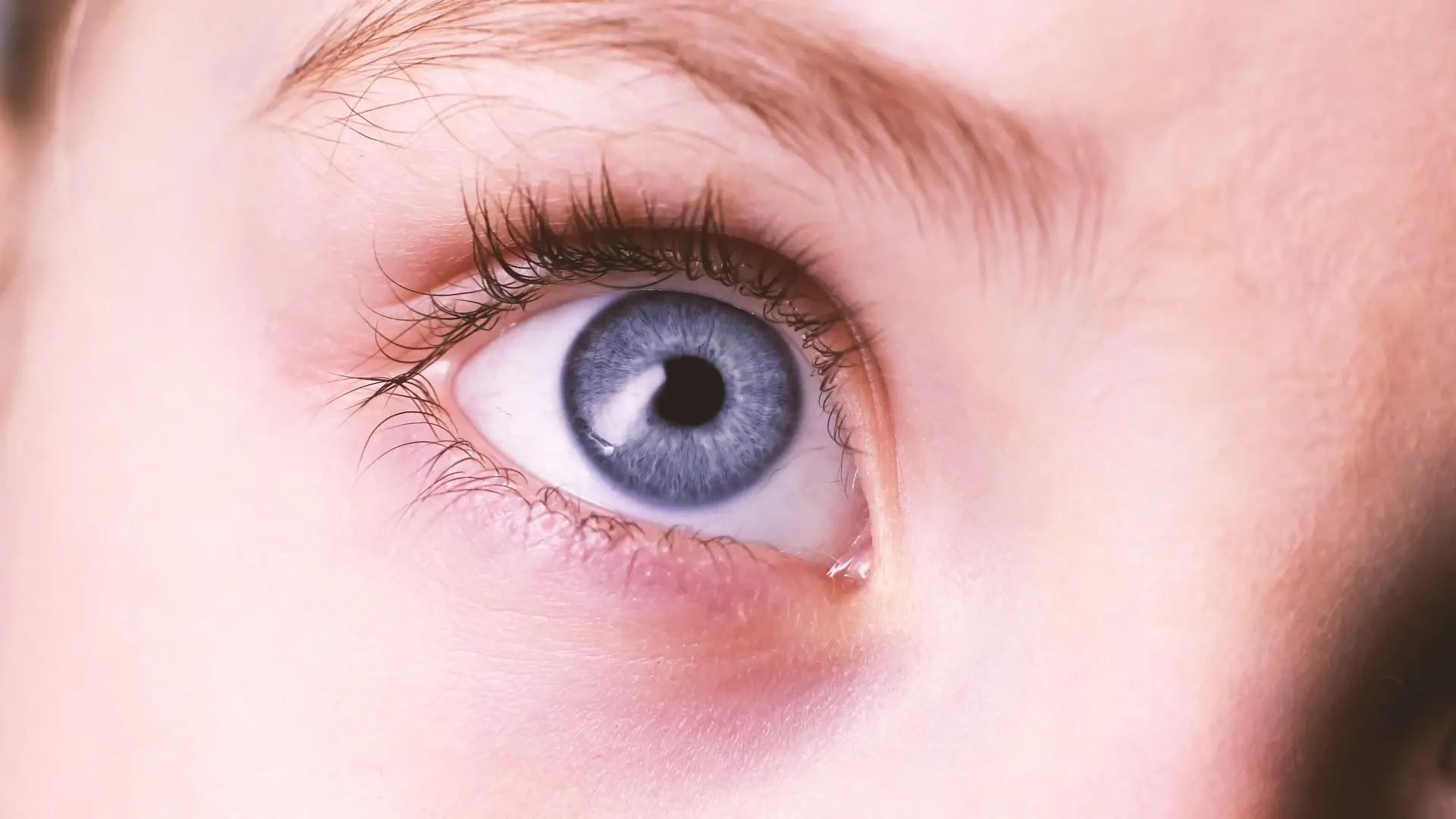 Eye Allergies (Allergic Conjunctivitis)