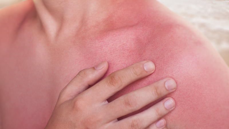image of a person's hand touching their sunburned shoulder