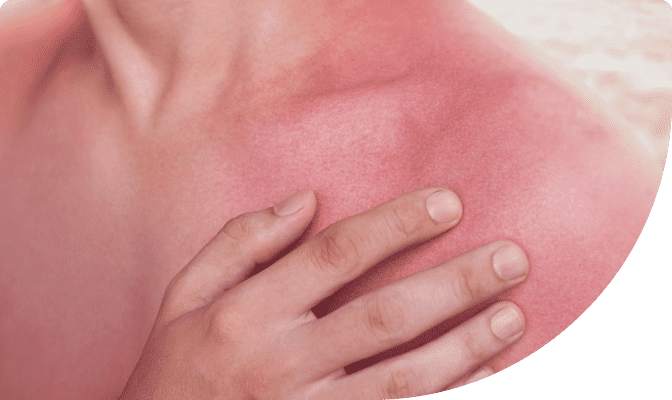 image of a person's hand touching their sunburned shoulder